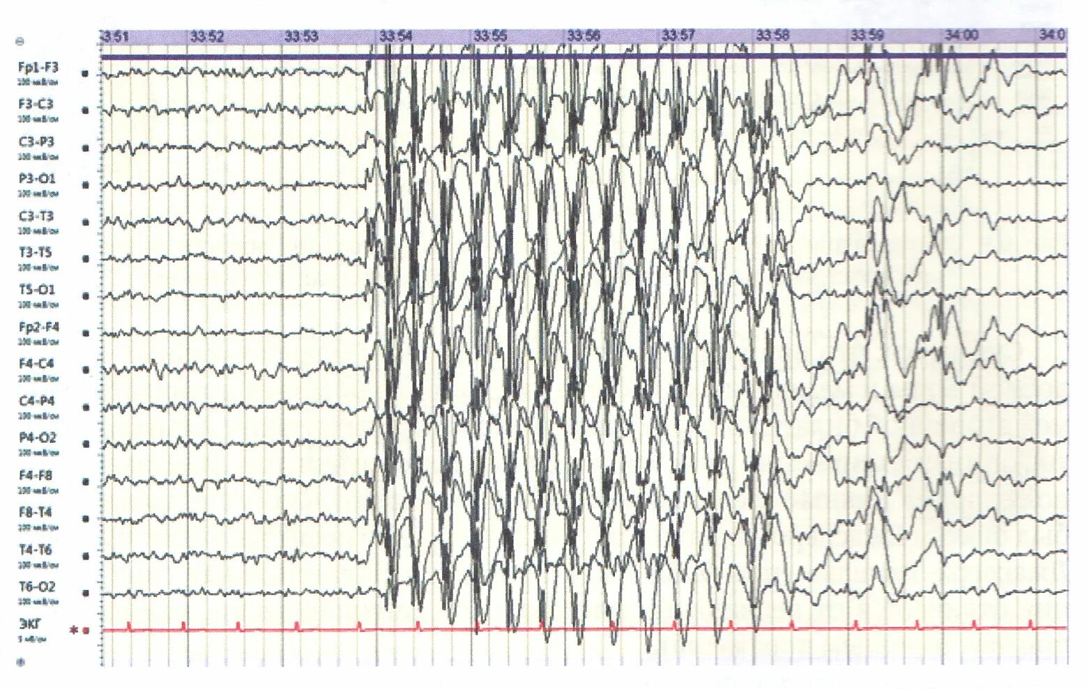 Медленные волны на ээг. Эпилептиформная активность на ЭЭГ. Эпилептиформные паттерны детства на ЭЭГ. Пик медленная волна на ЭЭГ что это. Генерализованные комплексы пик волна на ЭЭГ.
