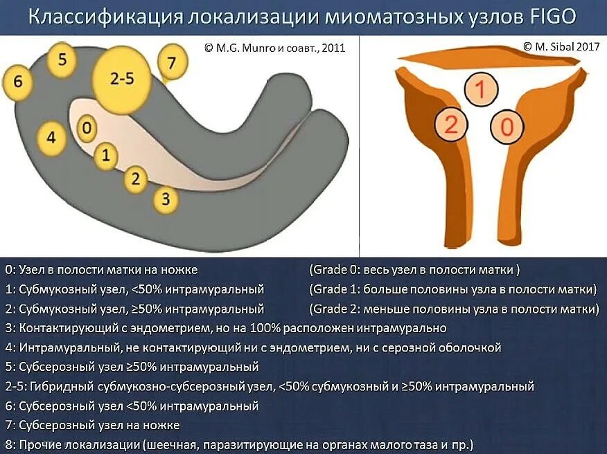 Можно делать массаж при миоме матки. Миома матки классификация по размерам. Классификация миом по УЗИ. Тип миоматозных узлов по Фиго. Миома матки классификация по локализации.