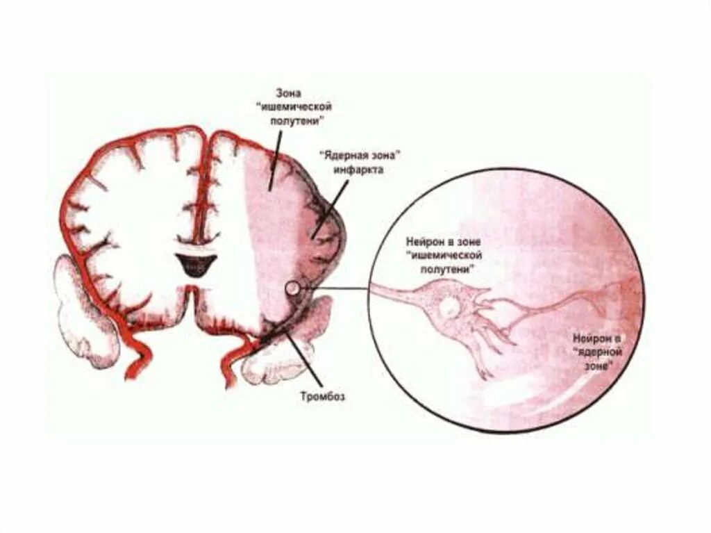 Болезнь ишемия мозга. Патогенез хронической ишемии головного мозга. Ишемическое поражение мозга. Недостаточное кровоснабжение головного мозга. Зоны ишемии головного мозга.