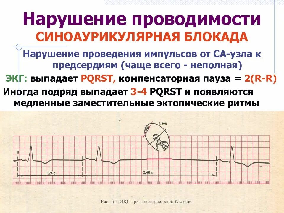 Нарушение атриовентрикулярной проводимости на экг. Атриовентрикулярная блокада 3 степени на экг. Нарушения av проводимости. Проводимость вид нарушения. Нарушения av проводимости.
