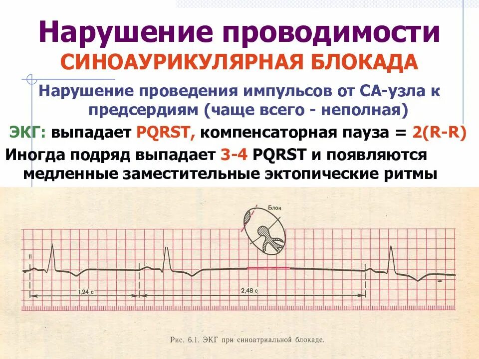 Синоаурикулярная блокада. Нарушение проводимости блокады сердца. Нарушение проводимости блокады ЭКГ. Блокада синусового узла 2 степени. Внутрипредсердная блокада на ЭКГ.