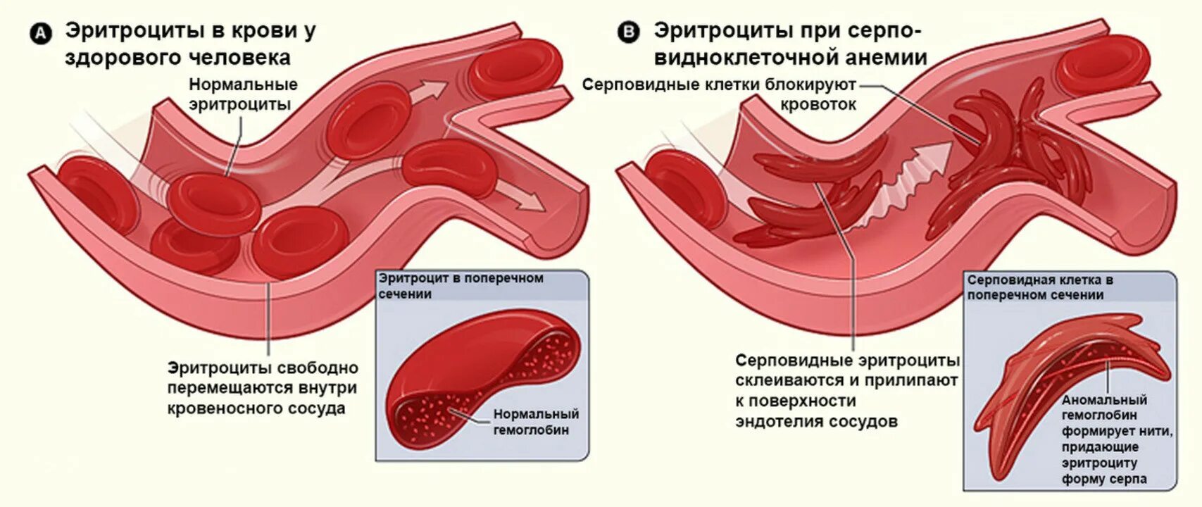 Дефекты эритроцитов. Эритроцит в разрезе. внутреннее строение эритроцитов.