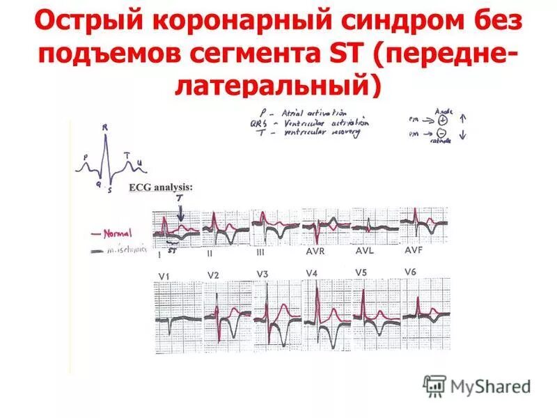 Экг подъем