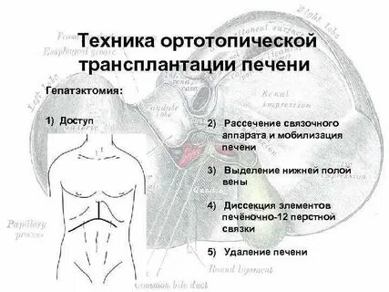 Пересадка печени квота