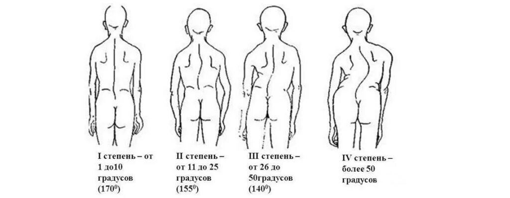 Сколиоз 4 степени у взрослых. Сколиоз 4 степени у взрослых