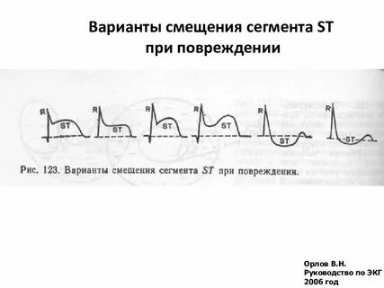 Ст экг