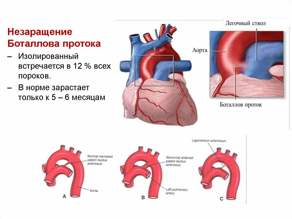 Персистирование боталлова протока. Боталлов проток незаращение. порок открытый боталлов проток. впс: - открытый баталов проток. порок сердца боталлова протока.