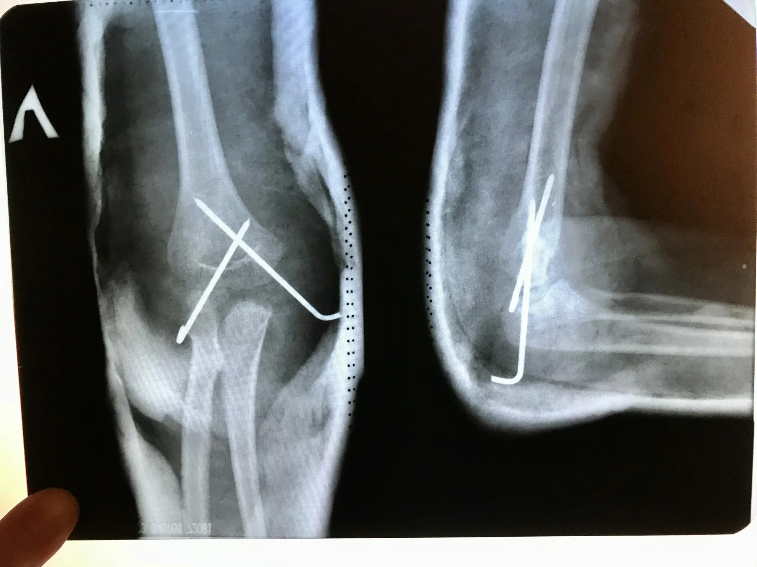 Чрезмыщелковый перелом со смещением. Чрезмыщелковый перелом плечевой кости рентген. Чрезмыщелковый перелом плечевой кости. Межмыщелковый перелом плечевой кости. Чрезмыщелковый перелом плечевой кости.
