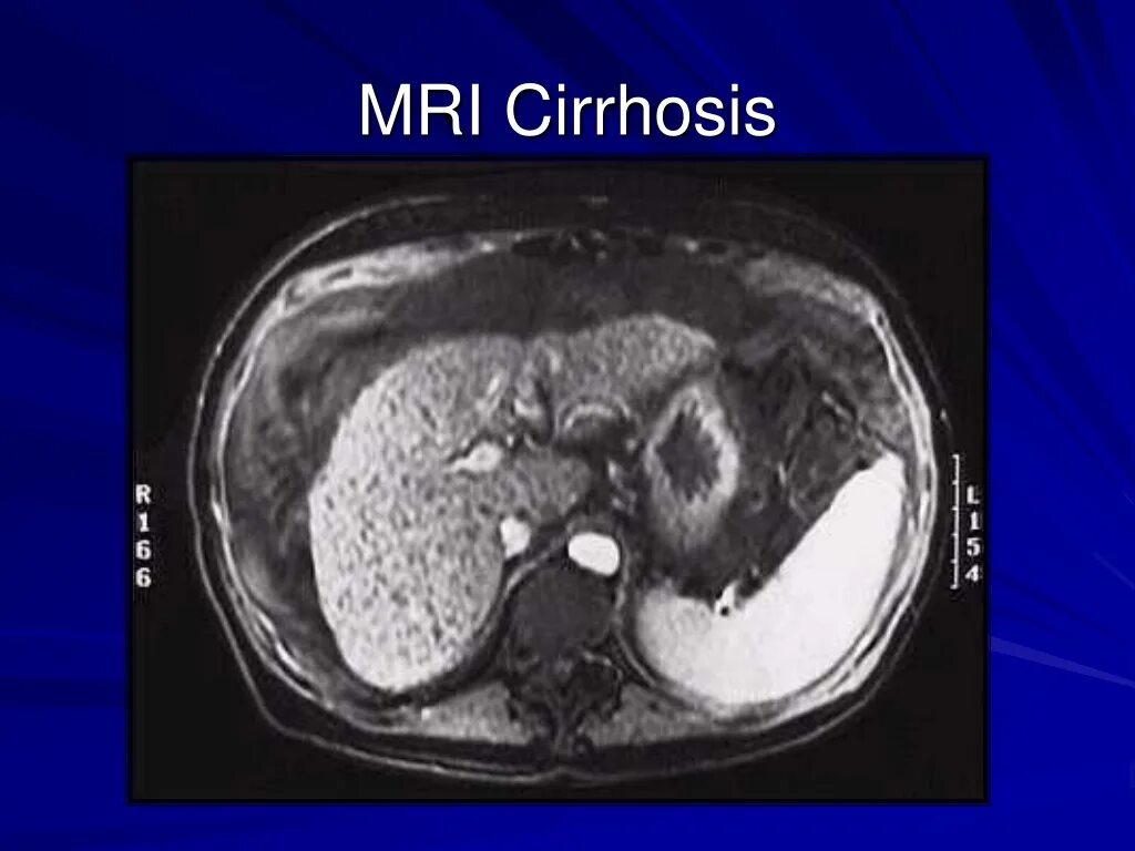 Магнитно-резонансная томография печени. Узловой цирроз печени на кт. Компьютерная томография цирроза печени. Кт норма печень
