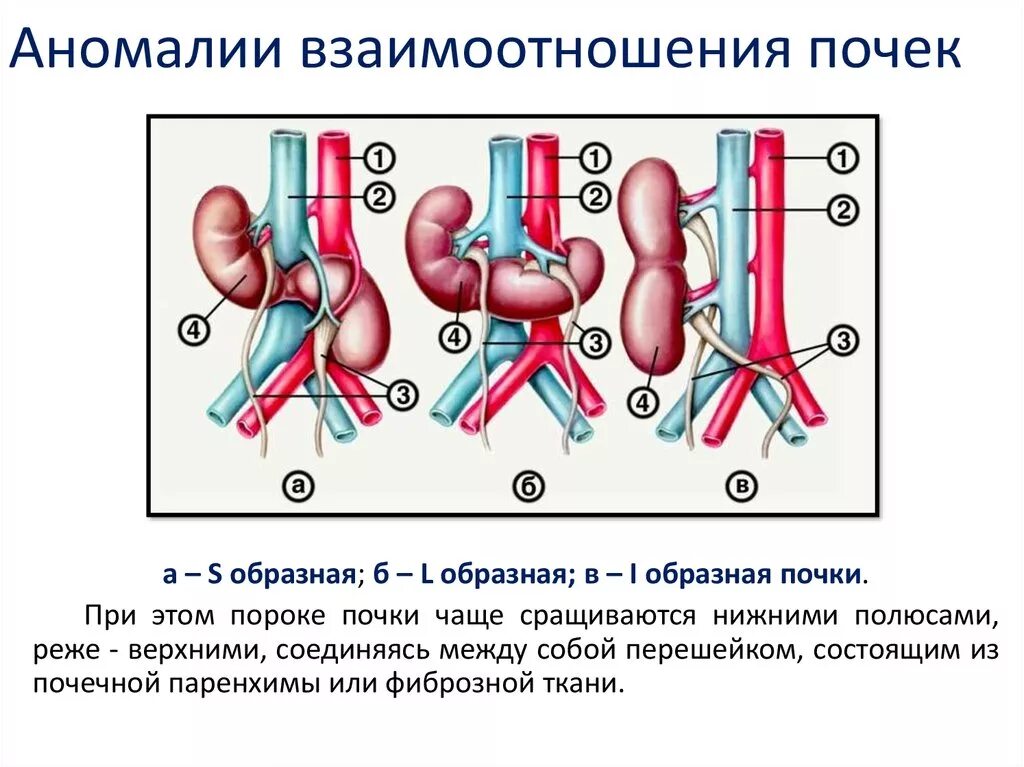 Аномалии строения. Аномалии развития почек классификация. аномалии взаимоотношения - сращение почек. классификация врожденных патологий почек. аномальное развитие почек.