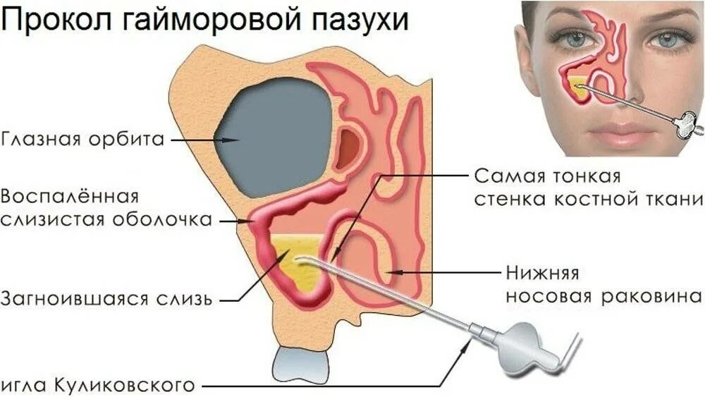 Можно делать операция насморке. Диагностическая пункция гайморовой пазухи. Гайморит прокол гайморовой пазухи. Протокол операции пункция гайморовой пазухи. Пункция верхнечелюстной пазухи носа.