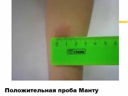 Реакция манту 6 мм