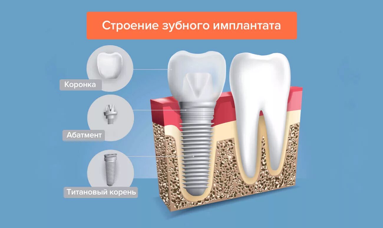 Схема имплант абатмент коронка. Имплант и формирователь десны схема. Имплант зуба абатмент. 5*10 осстем ts|||. Строение дентального имплантата.