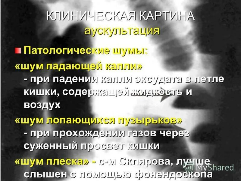 Шум падающего. Шум падающего. Симптом падающей капли. Шум падающей капли при аускультации. Звук упавшей книги.