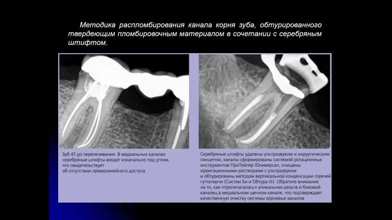 Пломбирование корневых каналов кальцием