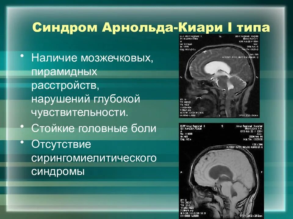 Мальформация Киари 1 типа. Арнольда Киари мрт критерии. Арнольда-Киари 1 типа симптомы. Аномалия арнольдаикиари.