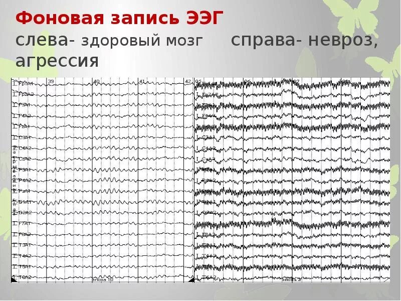 Хорошие результаты ээг. Нормальная диаграмма ЭЭГ. График ЭЭГ здорового человека. ЭЭГ головного мозга норма. ЭЭГ головного мозга здорового ребенка.