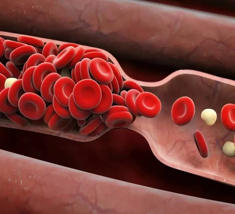 Тромбообразование в сосуде. Много тромбов