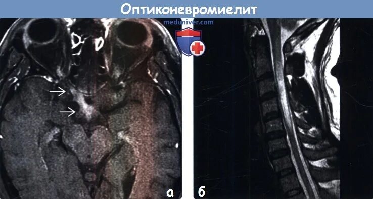 Оптиконевромиелит девика. Заболевание спектра оптиконевромиелита. Оптикомиелит девика симптомы. Рассеянный склероз оптикомиелит девика. Заболевание спектра оптиконевромиелита.