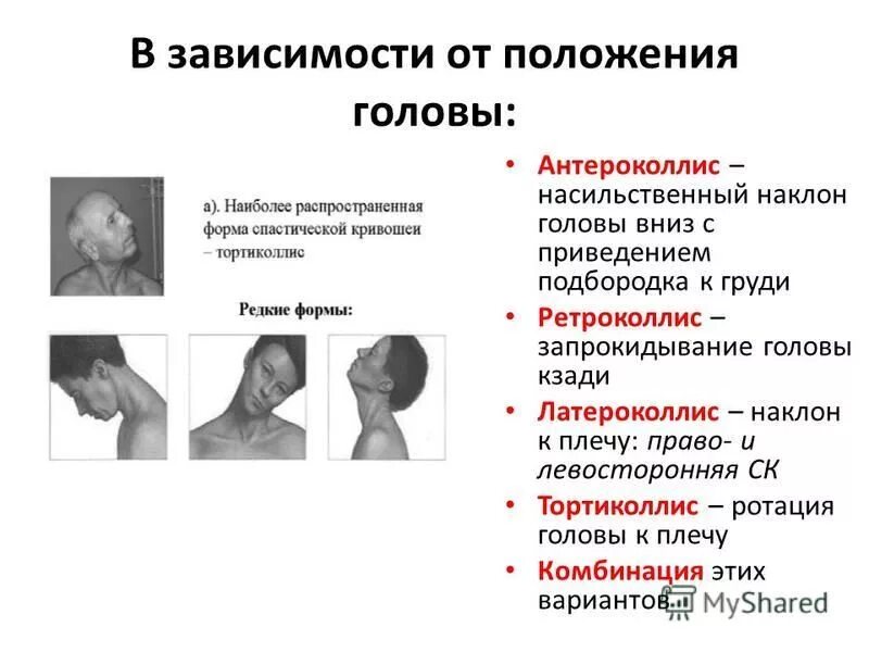 Голова наклонена вправо. Спастическая кривошея дистония. Цервикальная дистония кривошея. Клиническая картина спастической кривошеи. Спастическая кривошея тортиколлис.