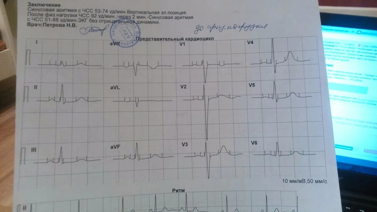 Заключение ЭКГ синусовая аритмия. ЭКГ синусовая тахикардия заключение ЭКГ. Синусовая аритмия на ЭКГ. Заключение ЭКГ при аритмии.