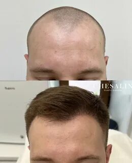 Сколько после пересадки волос