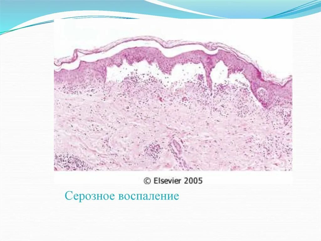 Воспаление серозной оболочки. Серозное воспаление полипа. Серозное воспаление кожи микропрепарат. Типы серозного воспаления в эпидермисе.