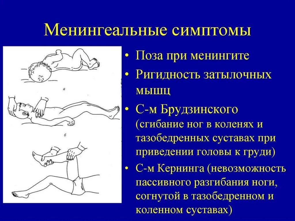 Менингеальные симптомы Кернига и Брудзинского. Симптом Кернига и Брудзинского. Менингеальные симптомы Кернига. Менингеальные знаки симптом Кернига.