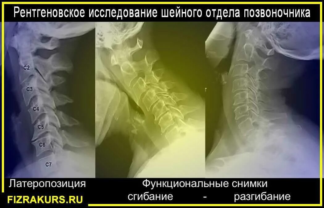 Функциональные пробы шейного отдела что это. Рентген шейного отдела позвоночника с функциональными пробами. дисторсия шейного отдела позвоночника рентген. смещение шейных позвонков рентген. рентген позвоночника со смещением позвонков.
