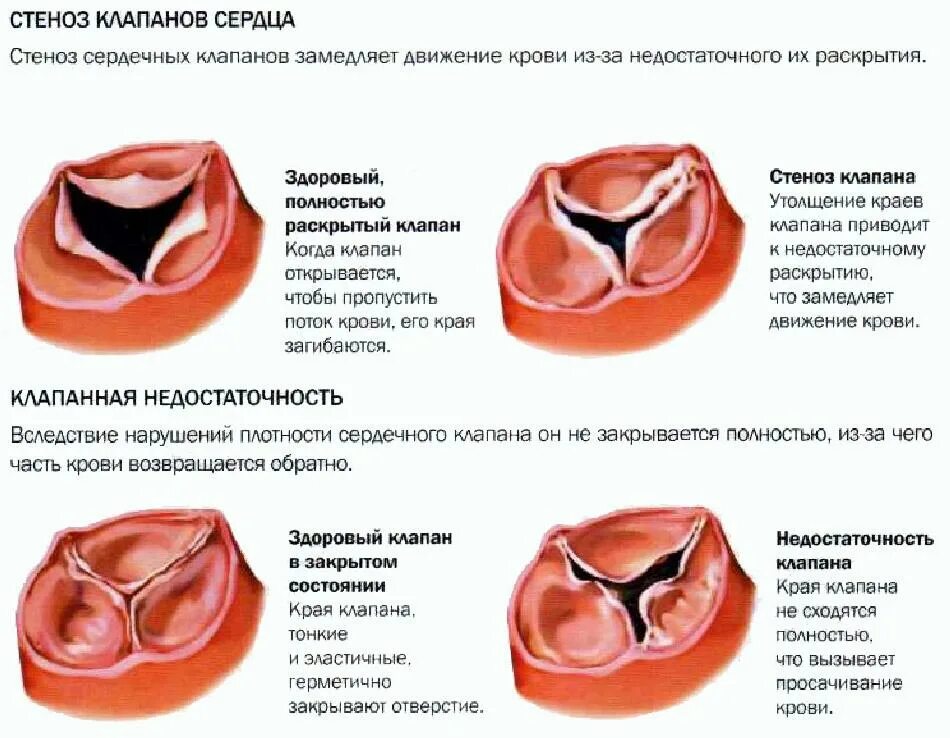 Можно вылечить стеноз. Стеноз аортального клапана и недостаточность аортального клапана. порок аортального клапана патанатомия. митральный клапан и аортальный клапан. порок сердца стеноз аортального клапана.