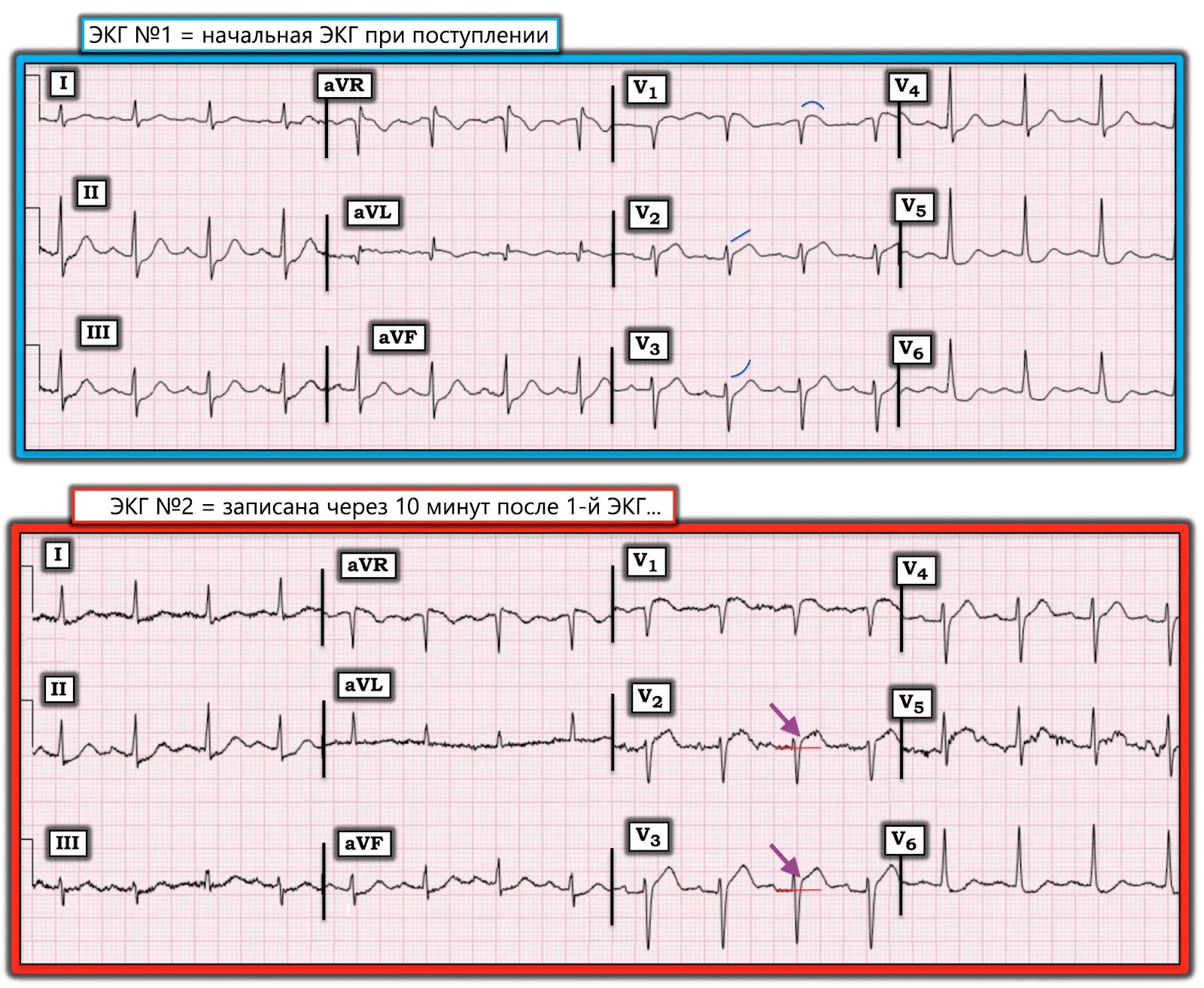 Отведение v6 на ЭКГ. Отведение v2 на ЭКГ норма. V1-v3 на ЭКГ. ЭКГ v1 v2 v3 v4 v5 v6 расшифровка. Отведение v1 на экг