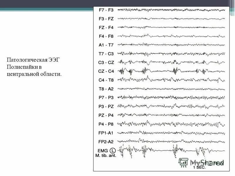 Активность ээг у ребенка что это. Исследование головного мозга ЭЭГ. Расшифровка электроэнцефалограммы головного мозга норма. Нормальная диаграмма ЭЭГ. Патологическая активность на ЭЭГ что это.