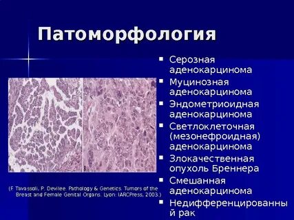 Доброкачественная соединительная опухоль