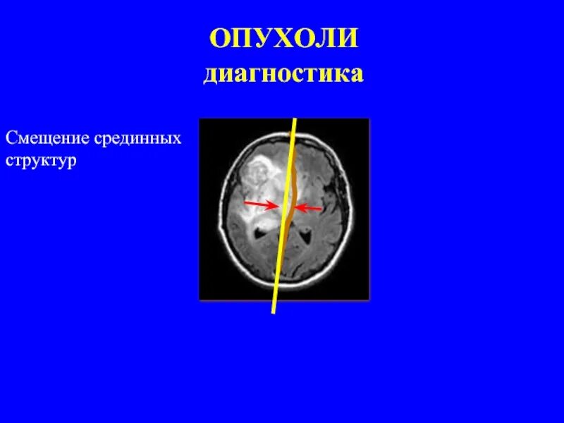 Изменения срединные структуры. Смещение срединных структур головного мозга мрт. смещение срединных структур головного мозга на кт. срединные структуры смещены вправо. срединные структуры мозга не смещены..
