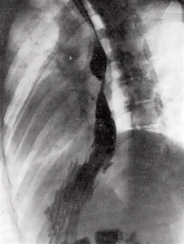 Врожденный короткий пищевод рентген. Короткий пищевод рентген. Врожденный короткий пищевод снимок. Внутренний короткий пищевод.