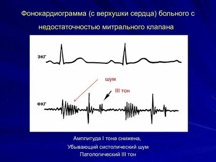 Тоны и шумы