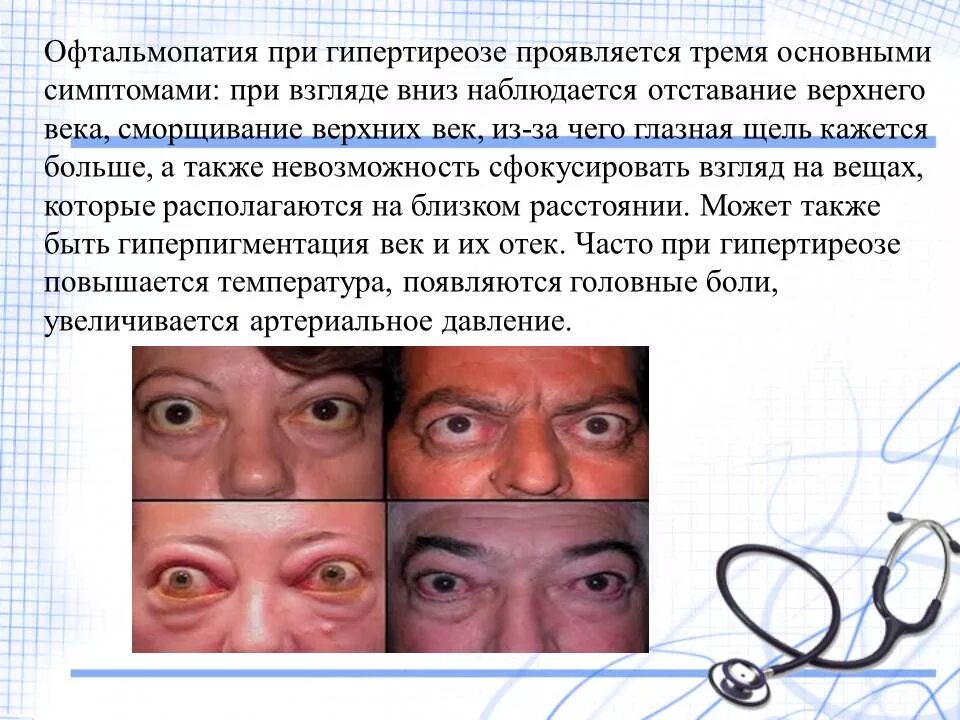 Экзофтальм наблюдается при. Эндокринная офтальмопатия. Офтальмопатия при гипертиреозе. Симптомы офтальмопатии. Эндокринная офтальмопатия синдромы.