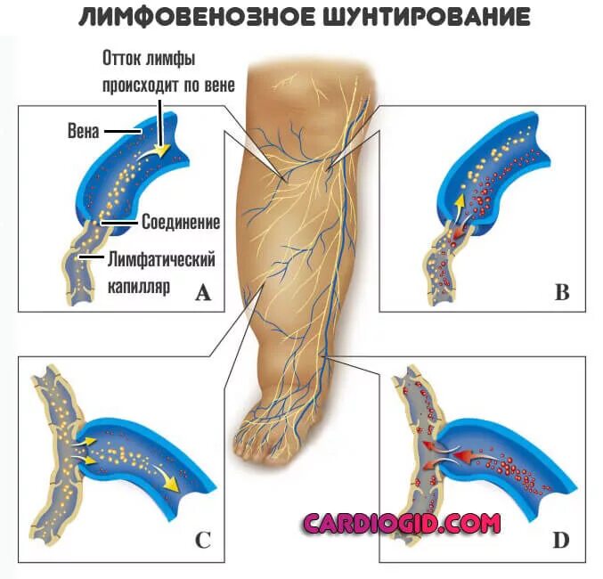 Как лечить лимфу
