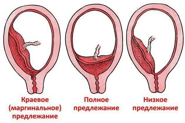 Предлежание плаценты операция. Предлежание плаценты и понрп. преждевременная отслойка плаценты.