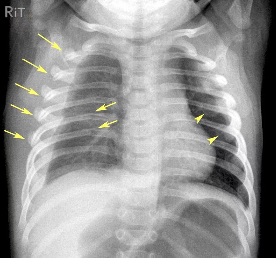 Флотирующий перелом ребер рентген. Рентген грудной клетки перелом ребер. Окончатый перелом ребер рентген.