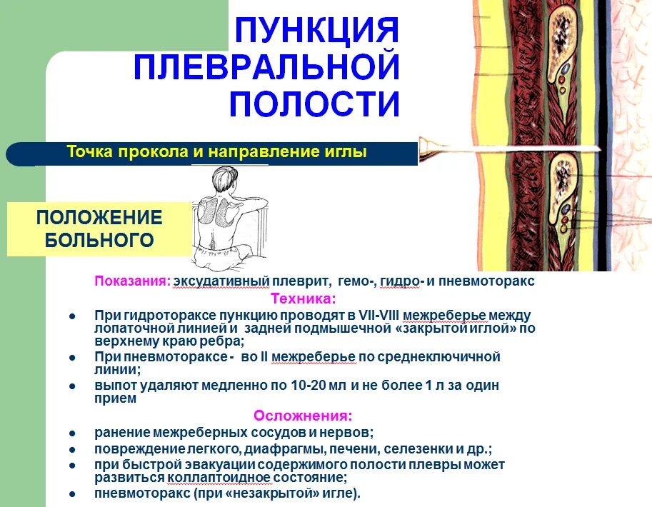 Техника выполнения плевральной пункции