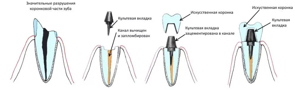 Почему открывают зуб. Культевая вкладка и коронка схема. Культевая вкладка со штифтом. Коронка на зуб штифт или вкладка. Культевая Штифтовая вкладка препарирование.