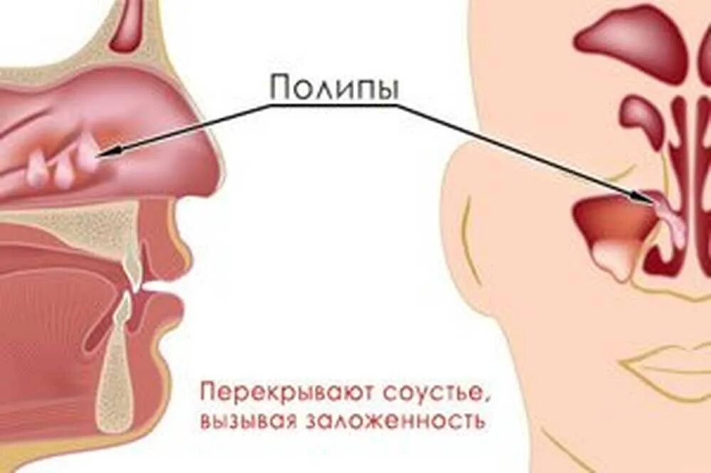 Двусторонний гнойный. Хронический гайморит Гнойный полипозный. Хронический Гнойный риносинусит. Хронический полипозный риносинусит.