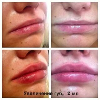 Можно ли делать губы на гв