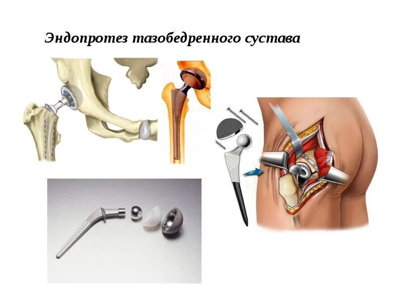 Эндопротез тазобедренного сустава устройство. Тотальное эндопротезирование тазобедренного сустава схема. Эндопротез тазобедренного сустава операция. Sanatmetal эндопротез тазобедренного сустава. Замена сустава тазобедренного когда можно садиться