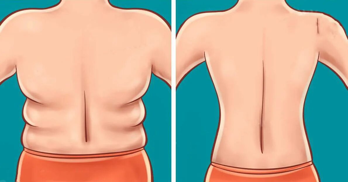 Удаление жира у мужчин. Жировая складка на пояснице. Складки на спине упражнения.
