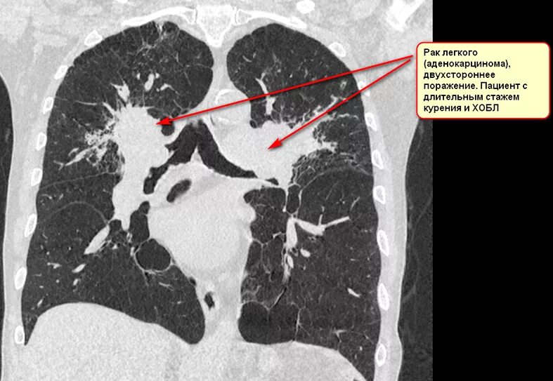 Хроническая обструктивная болезнь легких кт. Кт снимки ОГК. На кт видно опухоль