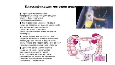 Операция рака мочевого пузыря у мужчин