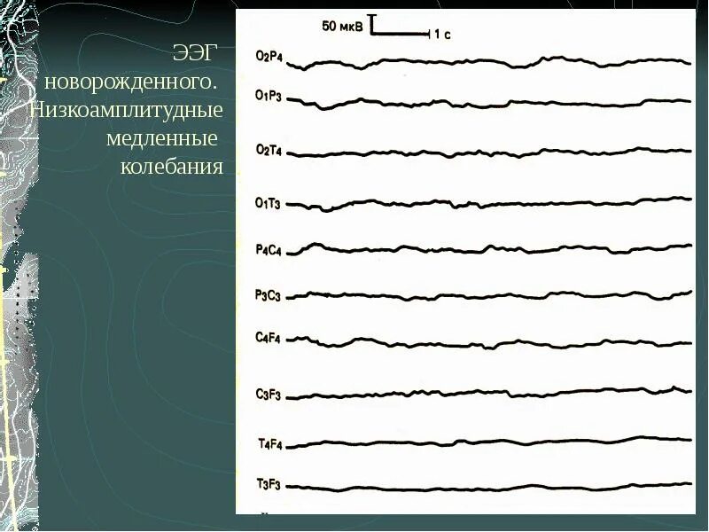 ЭЭГ новорожденному. Низкоамплитудная ЭЭГ. ЭЭГ детей в онтогенезе. Полиморфная ЭЭГ. Медленные волны на ээг