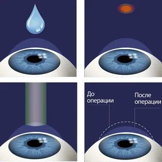 После лазерной коррекции зрение вблизи хуже